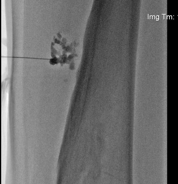 Hemangioma Embolisation